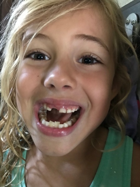 Lost tooth #3