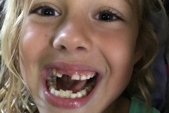 Lost tooth #3